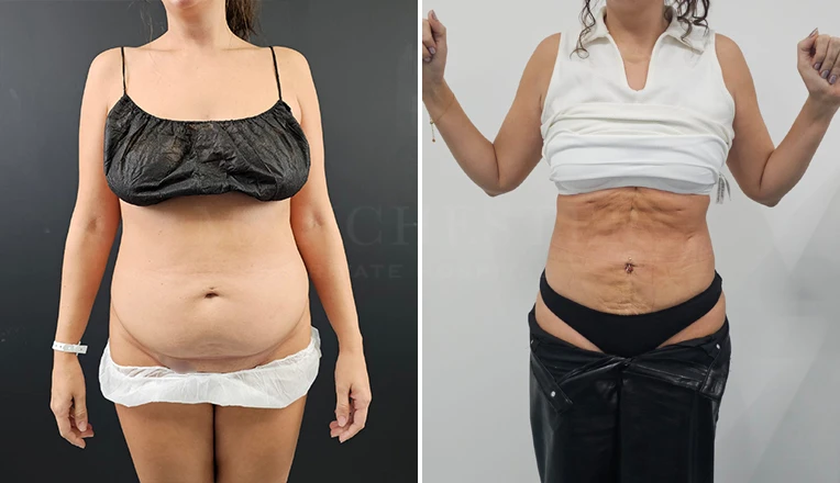 abdomen liposuction before and after result