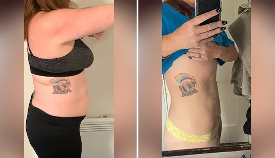 abdomen liposuction before and after