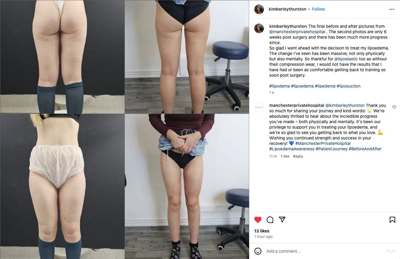 lipoedema patient experience