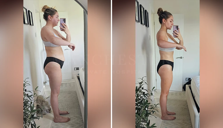 liposuction belly before and after-v1