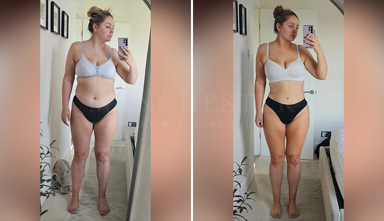 liposuction belly before and after