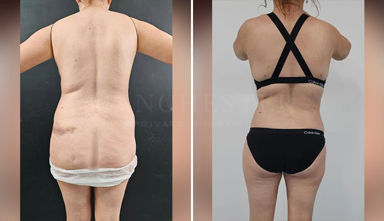 love handle vaser liposuction before and after​