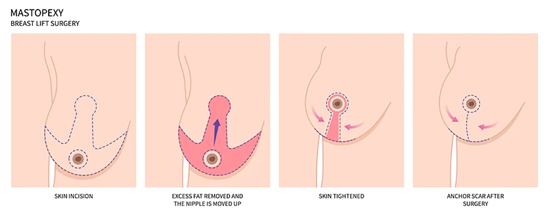 Illustration showing breast lift surgery with incision and scarring placements.