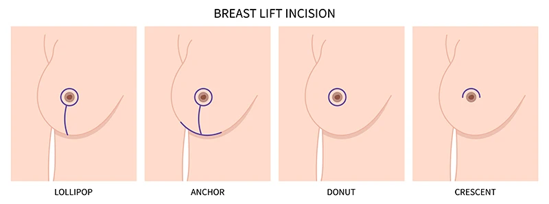 Illustration showing the four breast lift incision scars - lollopop, anchor, donut and crescent.