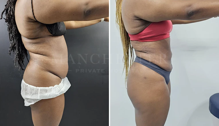 stomach liposuction before and after result-v1