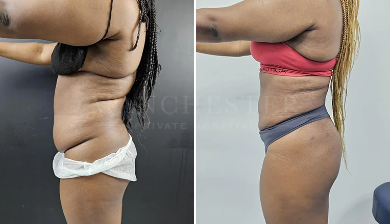 stomach liposuction before and after result-v2