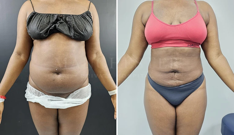 stomach liposuction before and after result