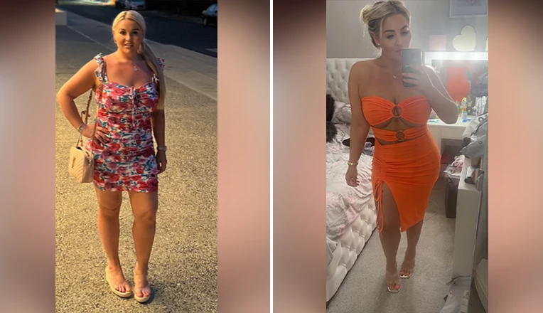 stomach liposuction before and after