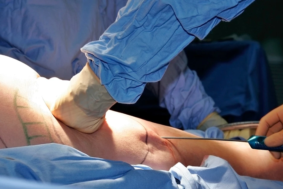 surgeon performing precise liposuction procedure in operating theatre