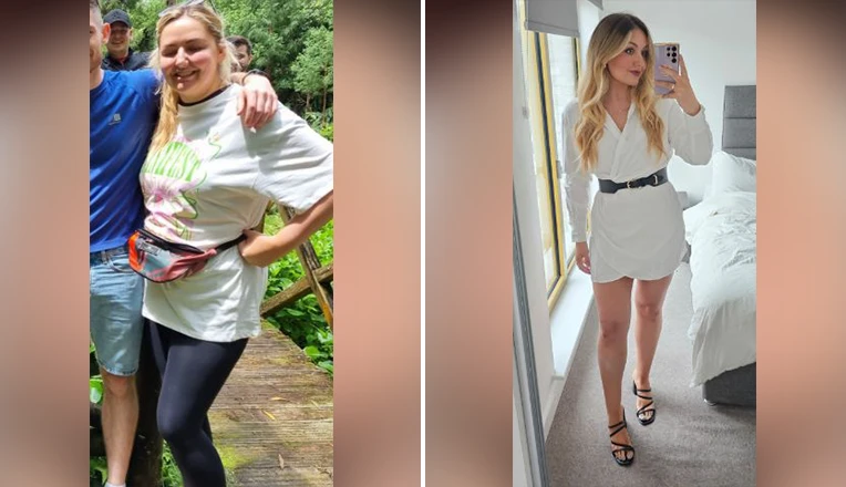 tummy liposuction before and after