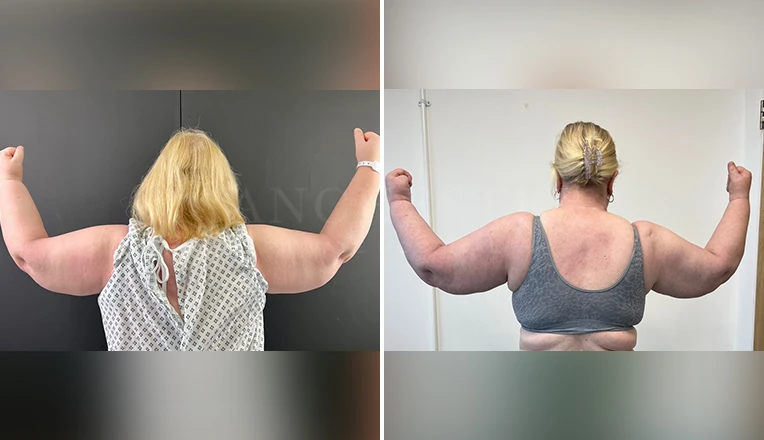 vaser Liposuction arms and forearms 360 lipoedema before and after patient result-1