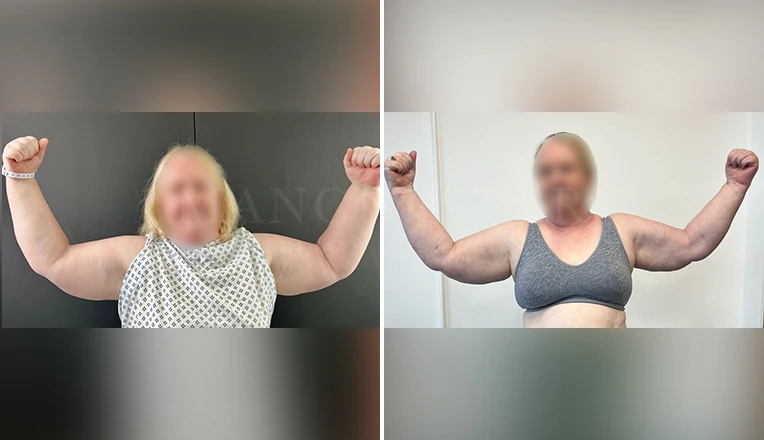 vaser Liposuction arms and forearms 360 lipoedema before and after patient result