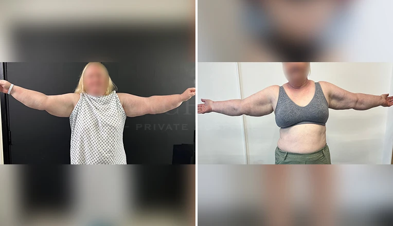 vaser Liposuction arms and forearms 360 lipoedema before and after