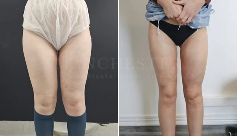 vaser liposuction legs before and after patient-8-v1