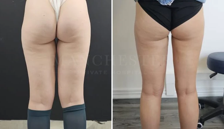 vaser liposuction legs before and after patient-8