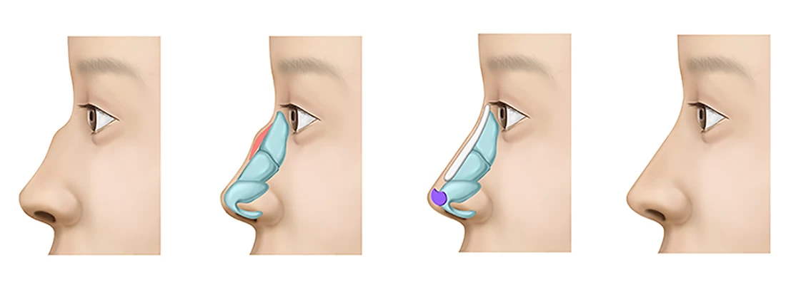 Illustration of rhinoplasty surgery showing nasal cartilage adjustments and structural changes in four stages
