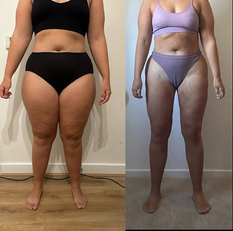 chloe-lipoedema-liposuction-patient-before-and-after