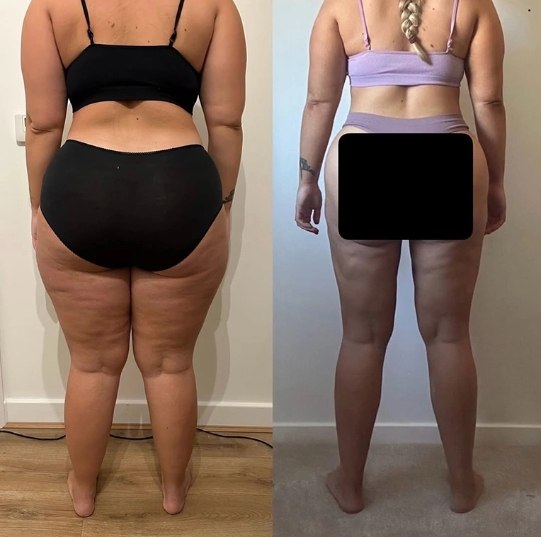 chloe-lipoedema-liposuction-patient-before-and-after