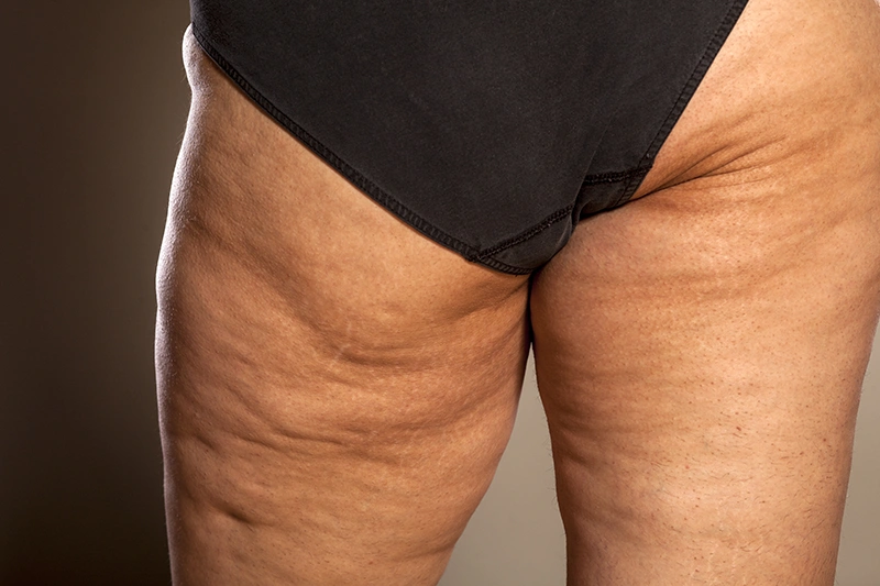lipedema-fat-distribution-thighs