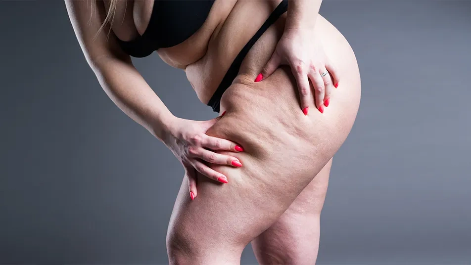 woman showing symptoms of lipedema on legs, highlighting skin texture before treatment