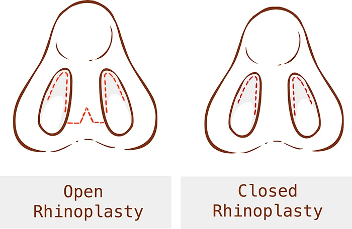 diagram comparing open rhinoplasty and closed rhinoplasty surgical incision techniques