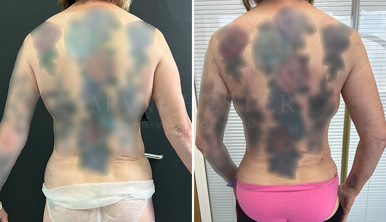 back vaser lipo before and after result-19