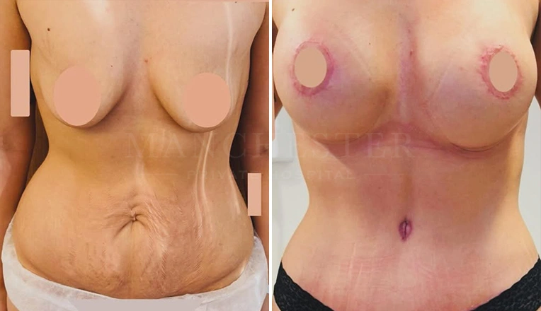 breast enhancement with an uplift and a tummy tuck