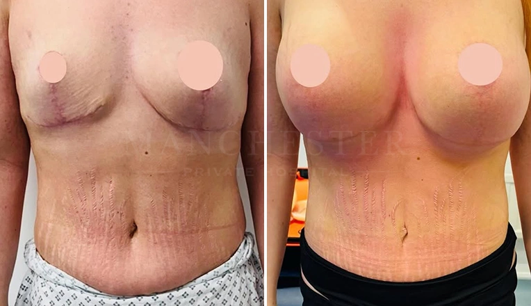 breast uplift and new breast augmentation plus tummy tuck-vaser liposuction