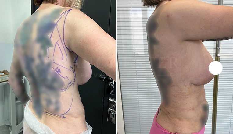 stomach vaser lipo before and after result-19-v1