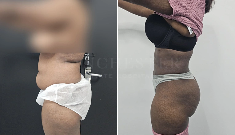 vaser lipo before and after stomach result-20-v1