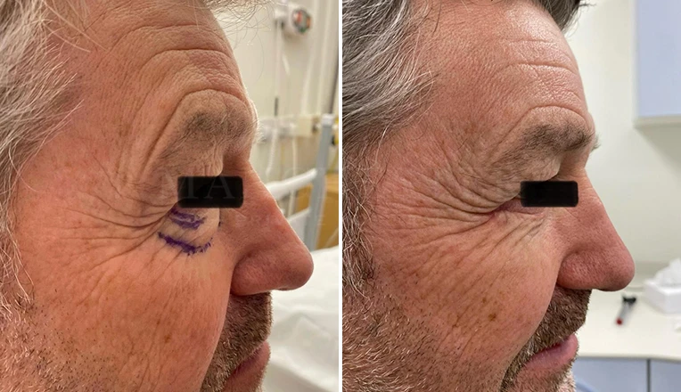 lower blepharoplasty before and after patient-15