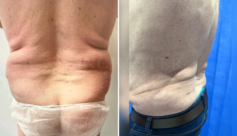 vaser lipo male abs before and after-16