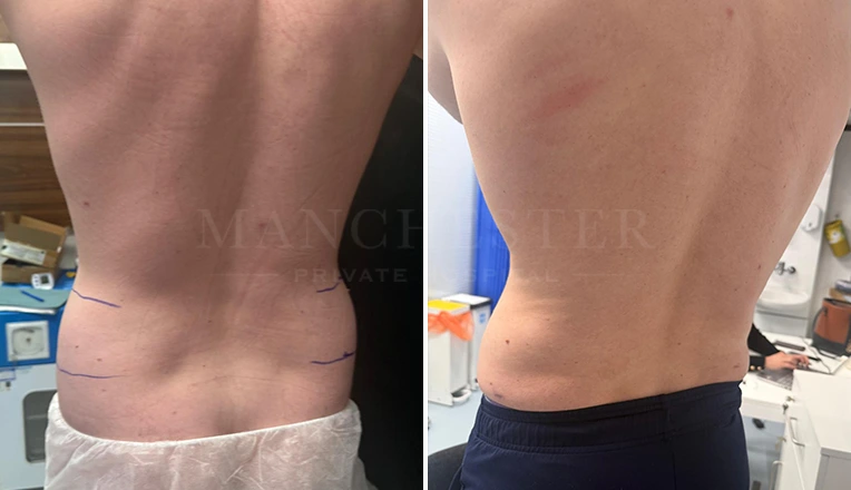 men love handle liposuction before and after