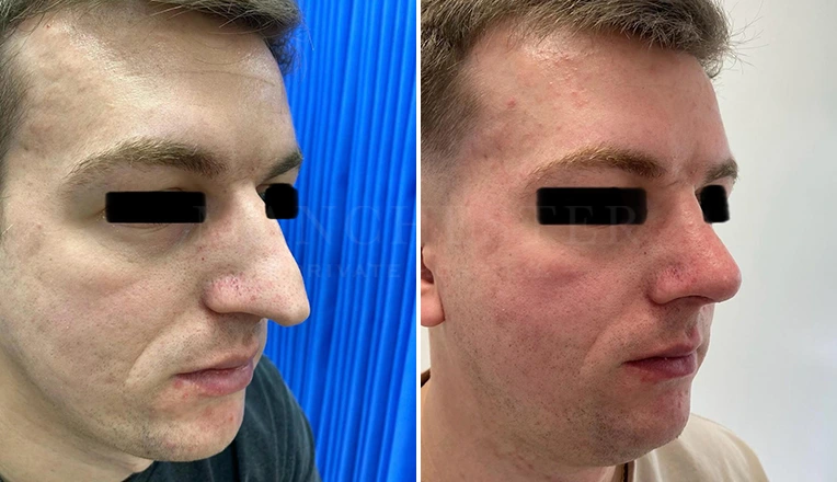 men nose job before and after result-3