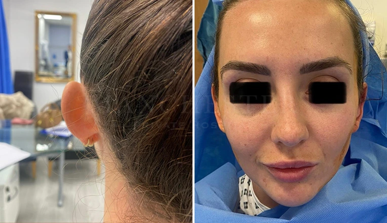 Pinnaplasty Before and After Result