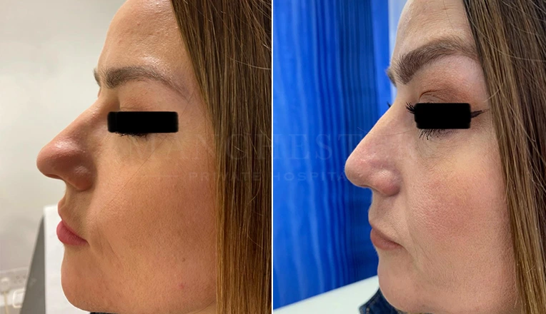 rhinoplasty before and after patient-17
