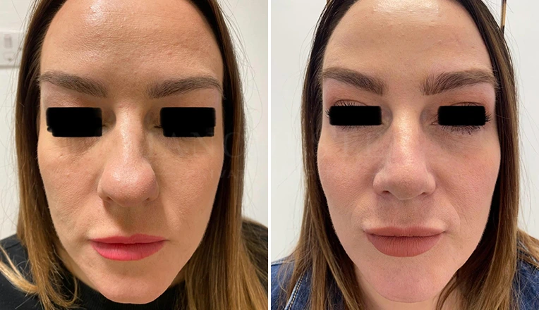 rhinoplasty before and after patient-17