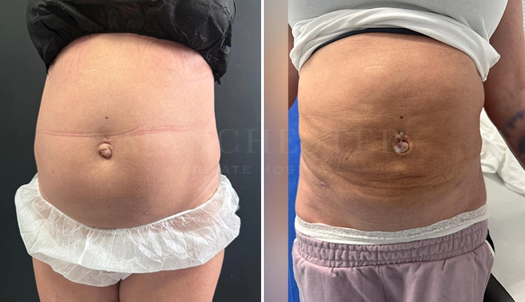 vaser lipo before and after abdomen flanks result-22