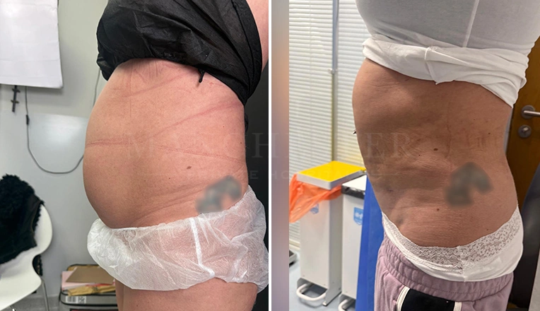 vaser lipo before and after abdomen flanks result-22