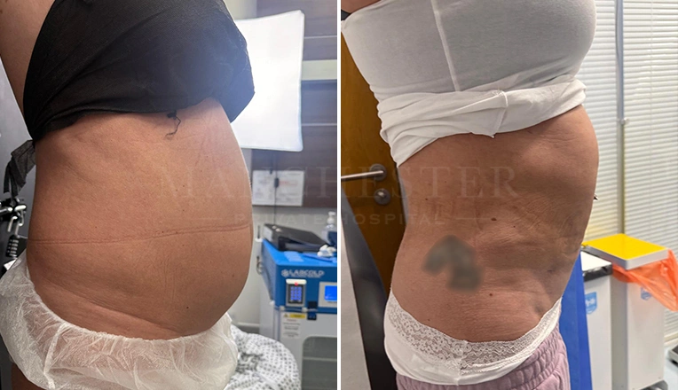 vaser lipo before and after abdomen flanks result-22