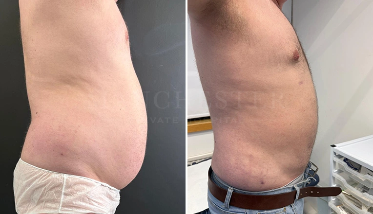 vaser lipo male abs before and after-15