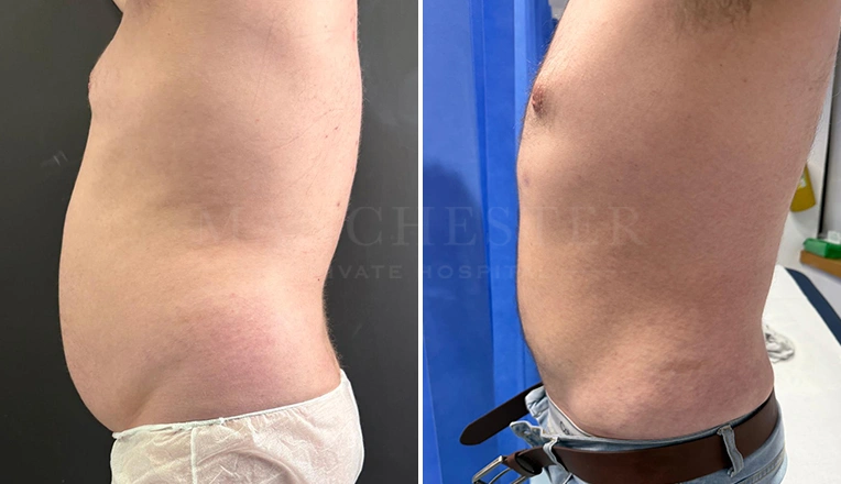vaser lipo male abs before and after-15
