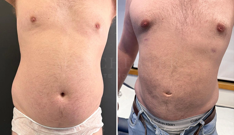 vaser lipo male abs before and after-15