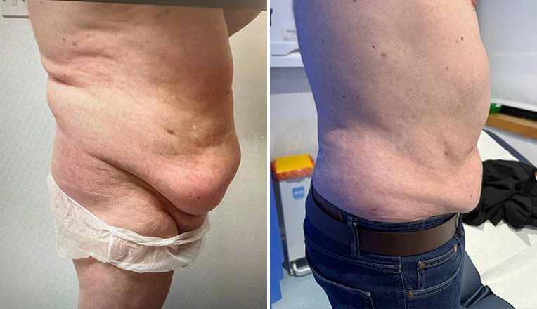 vaser lipo male abs before and after-16