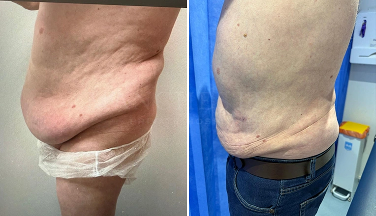 vaser lipo male abs before and after-16