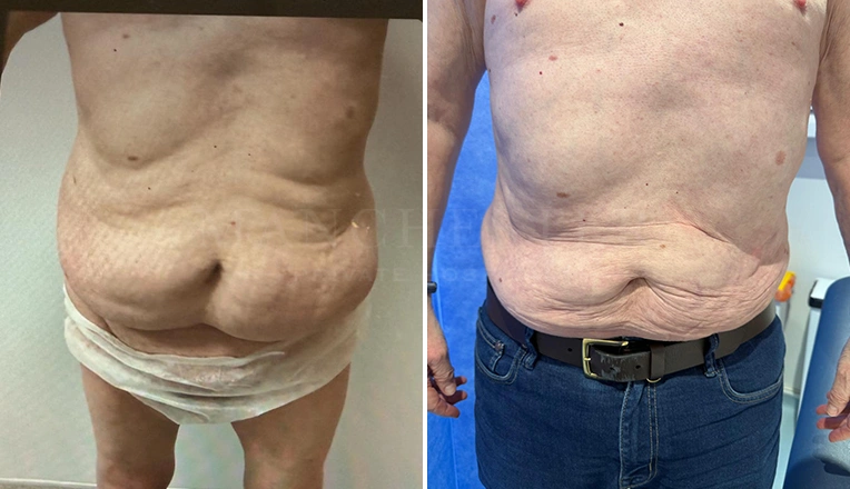 vaser lipo male abs before and after-16