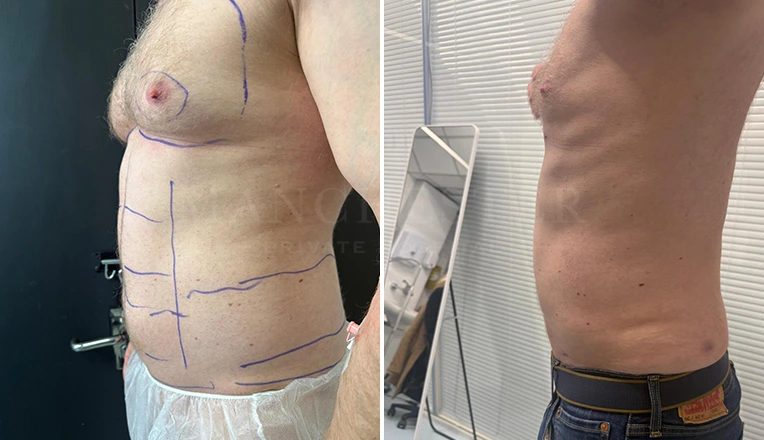 vaser lipo male abs before and after-17