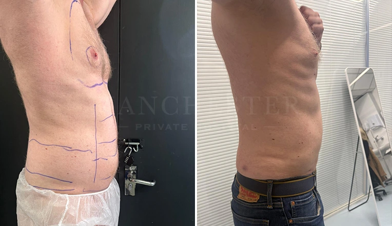 vaser lipo male abs before and after-17