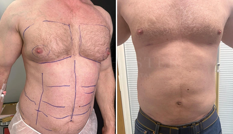 vaser lipo male abs before and after-17