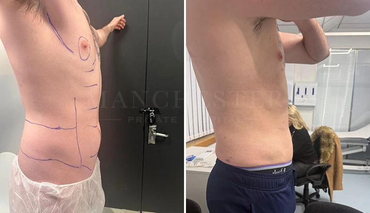 vaser lipo male abs before and after